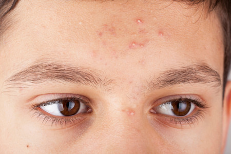 face with pimples