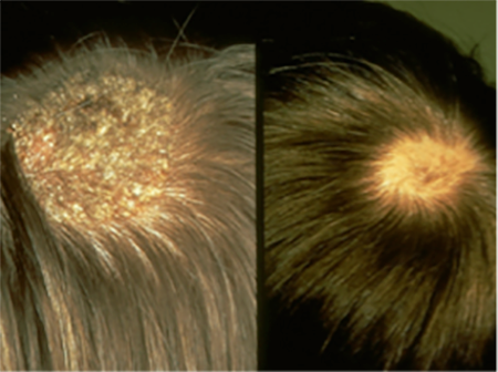 two pictures of scalp with ringworm