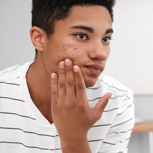 Good Skin Knowledge: Lesson plans: Module 6: Acne
