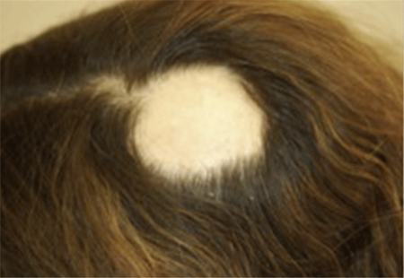 bald spot on top of head