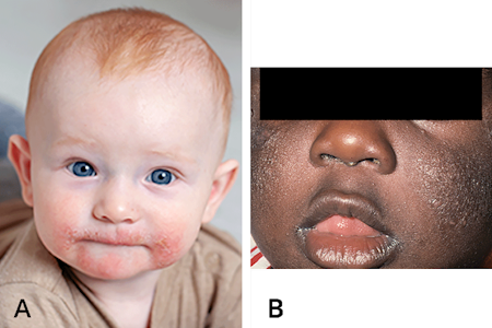 Atopic dermatitis on cheeks of baby with lighter skin tone and on face of baby with darker skin tone