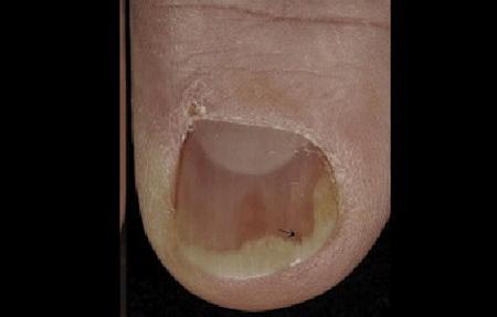 nail psoriasis causing tiny dents and white discolored nail