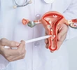 Qué es el Cáncer de cuello uterino, causas y síntomas - Nosotras