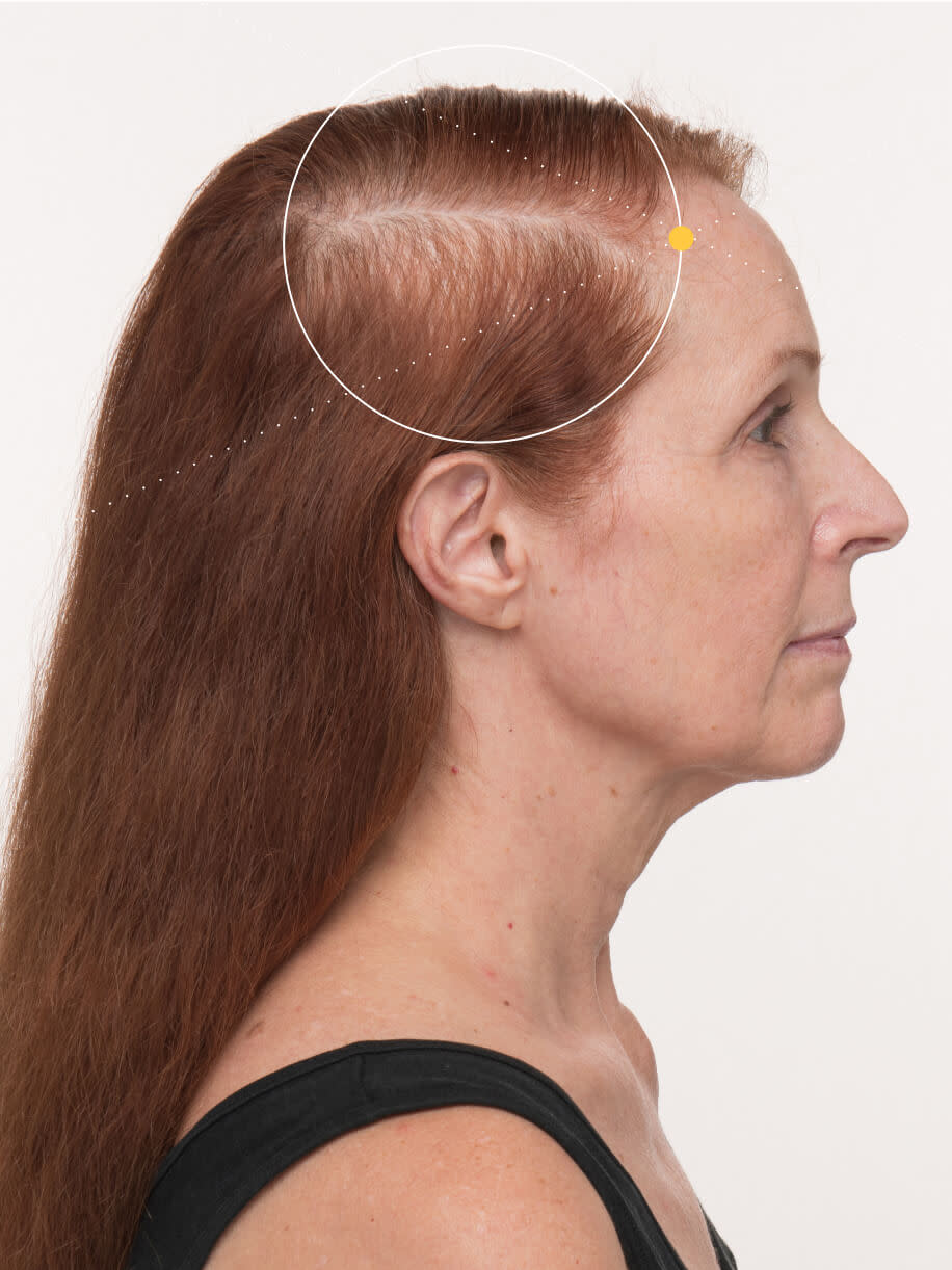 Lydia before taking Nutrafol Women’s Balance Hair Growth Nutraceutical.