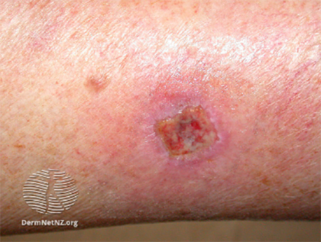 Infected skin