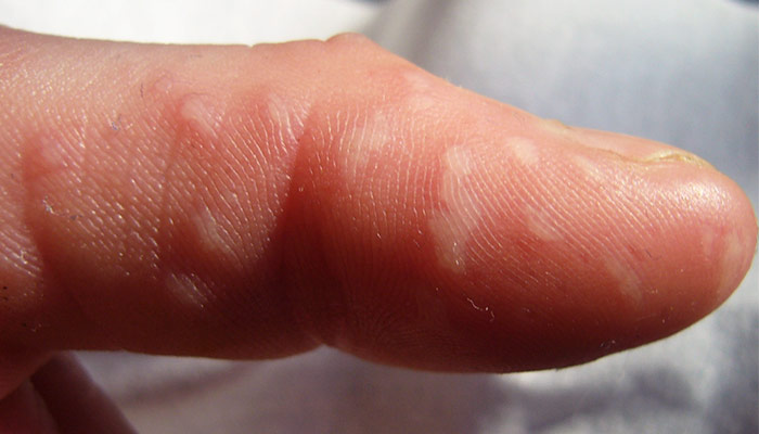 Höstblåsor på finger med ljus hud