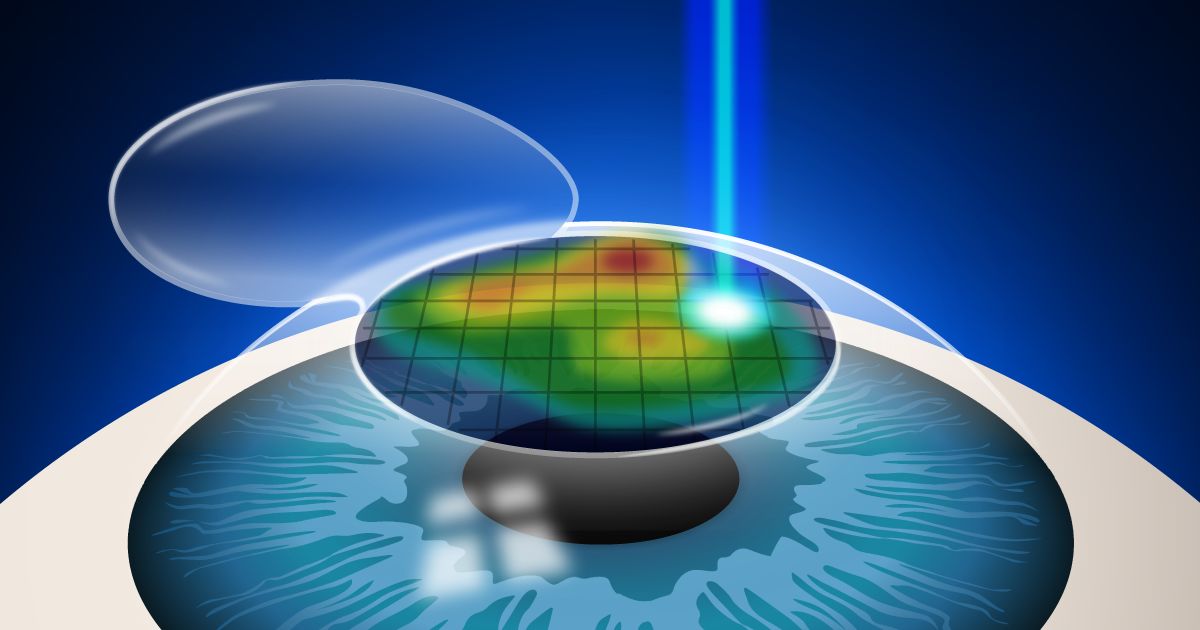 Lasik de frente de onda personalizado