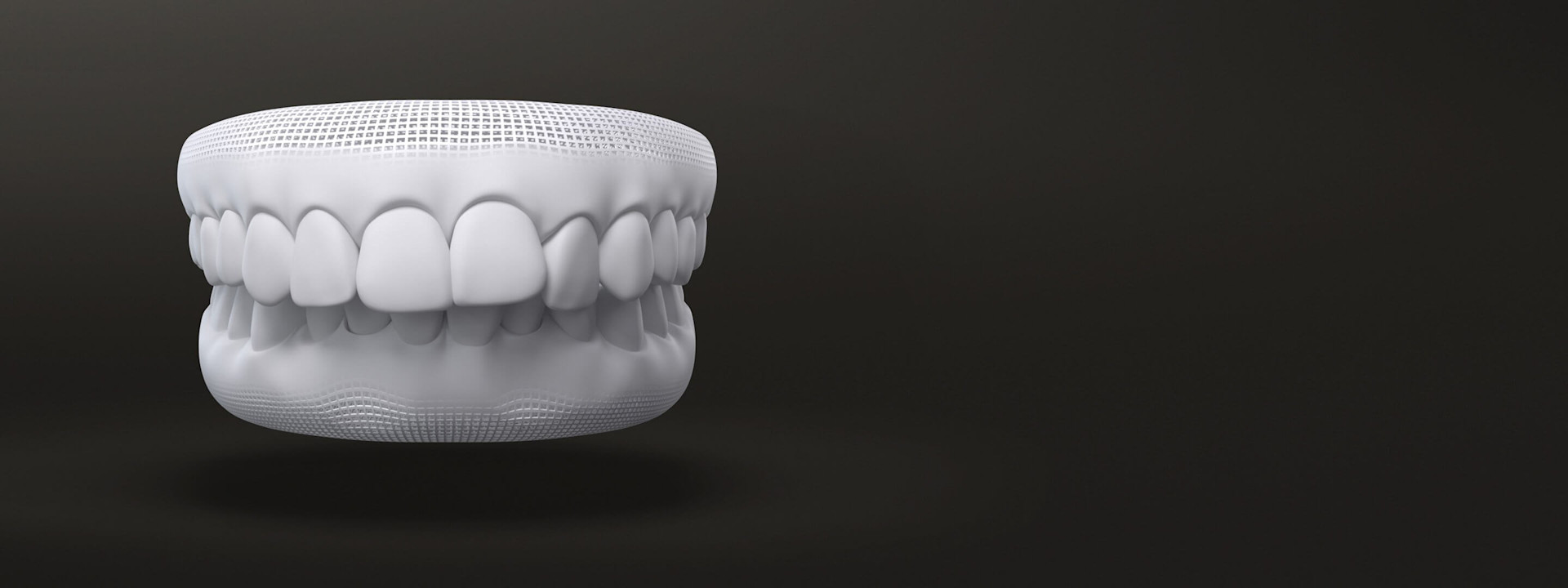 Over bite 3D model - Invisalign treatments - UK