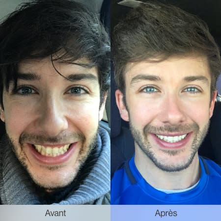 Invisalign Europe treatment: before and after
